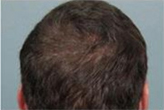 FUE hair transplant after